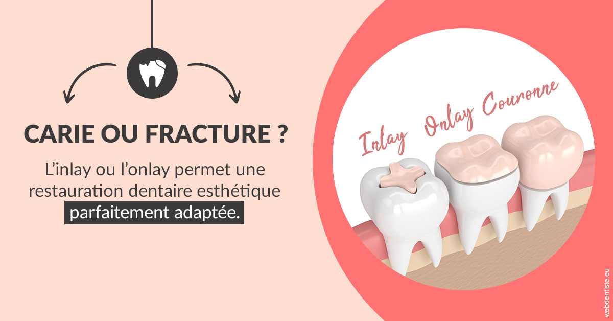 https://dr-dussere-lm.chirurgiens-dentistes.fr/T2 2023 - Carie ou fracture 2