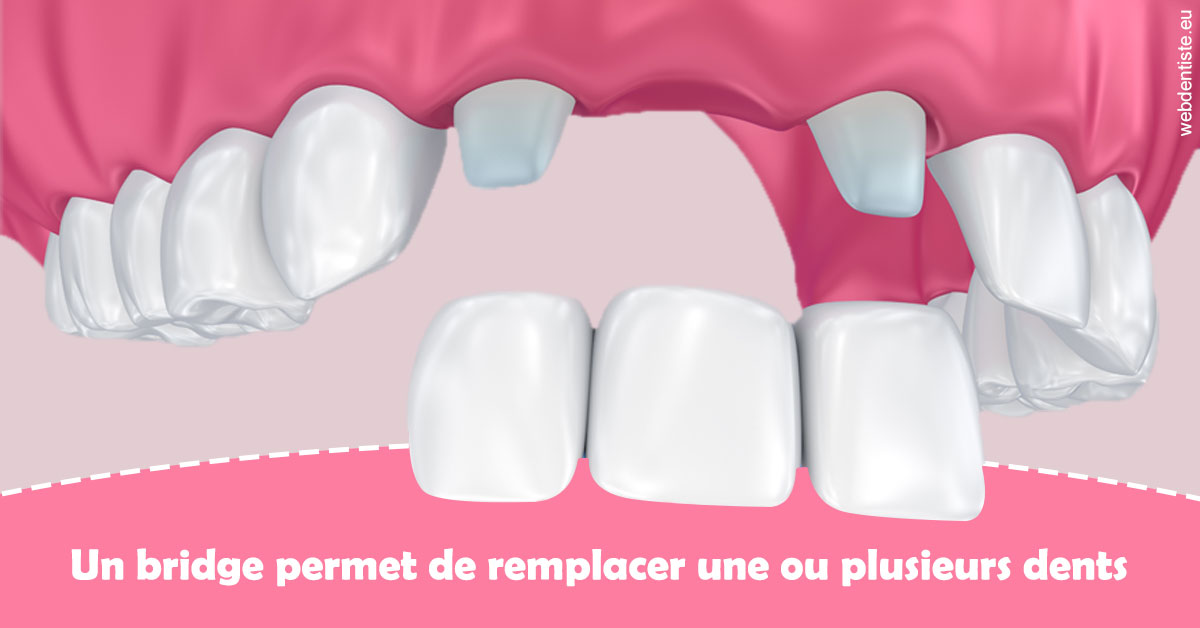 https://dr-dussere-lm.chirurgiens-dentistes.fr/Bridge remplacer dents 2