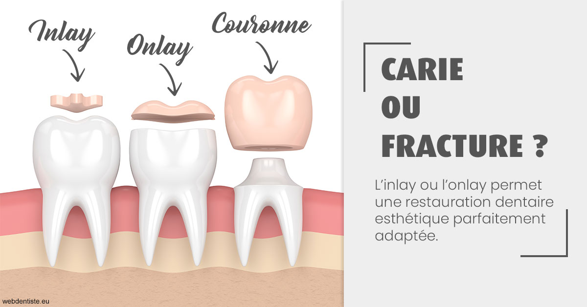 https://dr-dussere-lm.chirurgiens-dentistes.fr/T2 2023 - Carie ou fracture 1