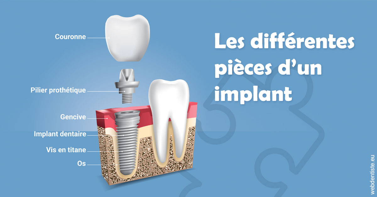 https://dr-dussere-lm.chirurgiens-dentistes.fr/Les différentes pièces d’un implant 1